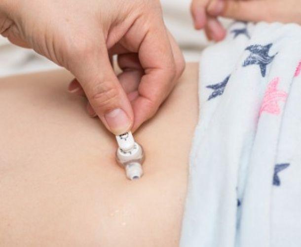 Wechsel Button und Gastrotube