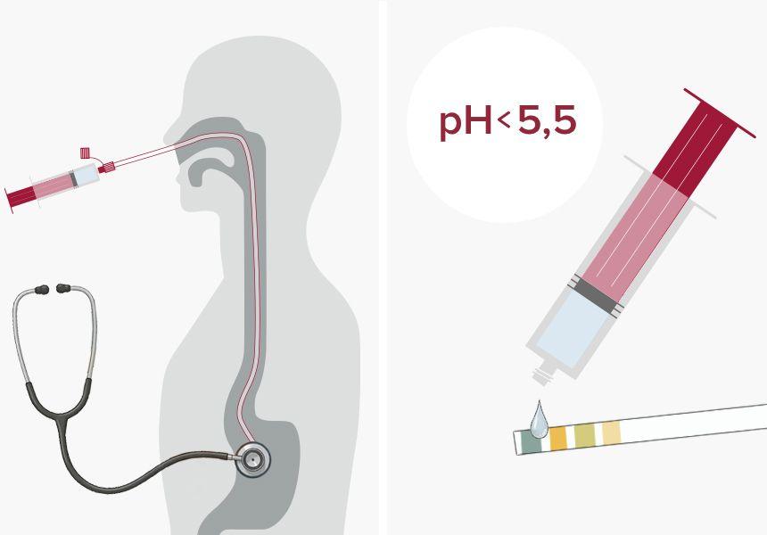 Lagekontrolle Nasensonde