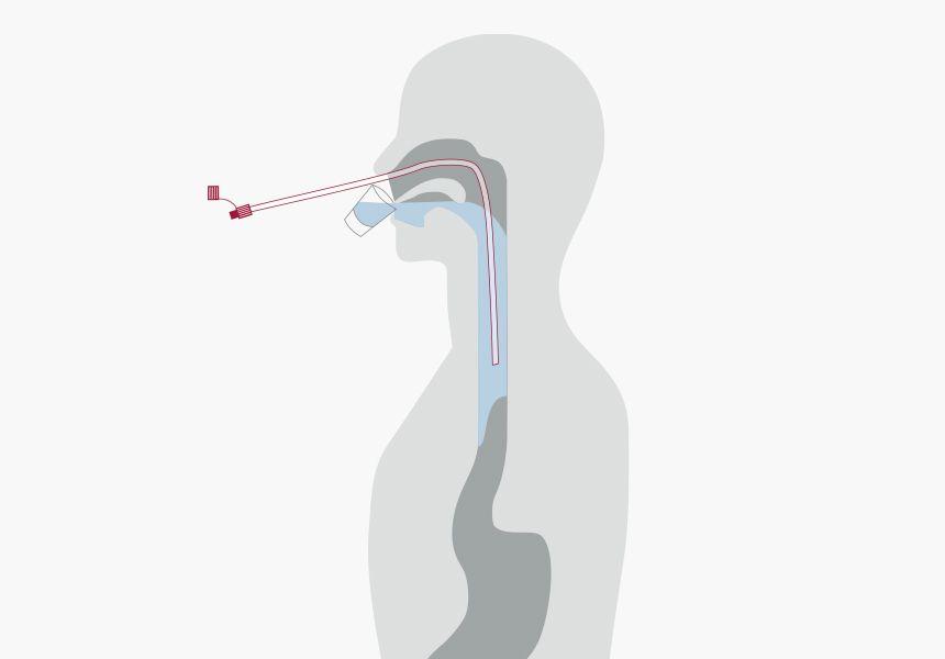 Legen der Nasensonde
