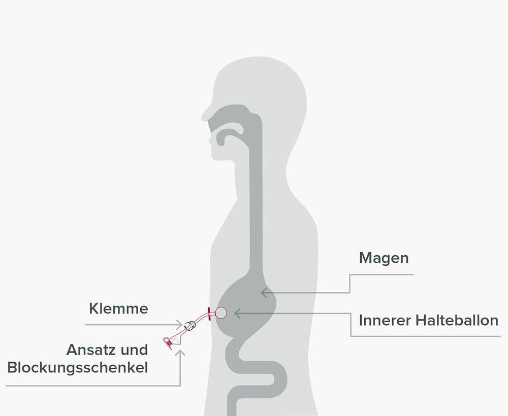 Der Gastrotube ist eine perkutane Austauschsonde.