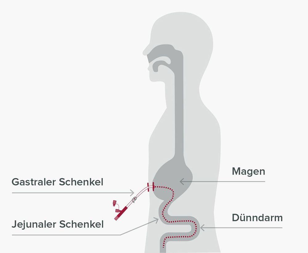 Perkutane Dünndarmsonden: JET-PEG und PEG/J.