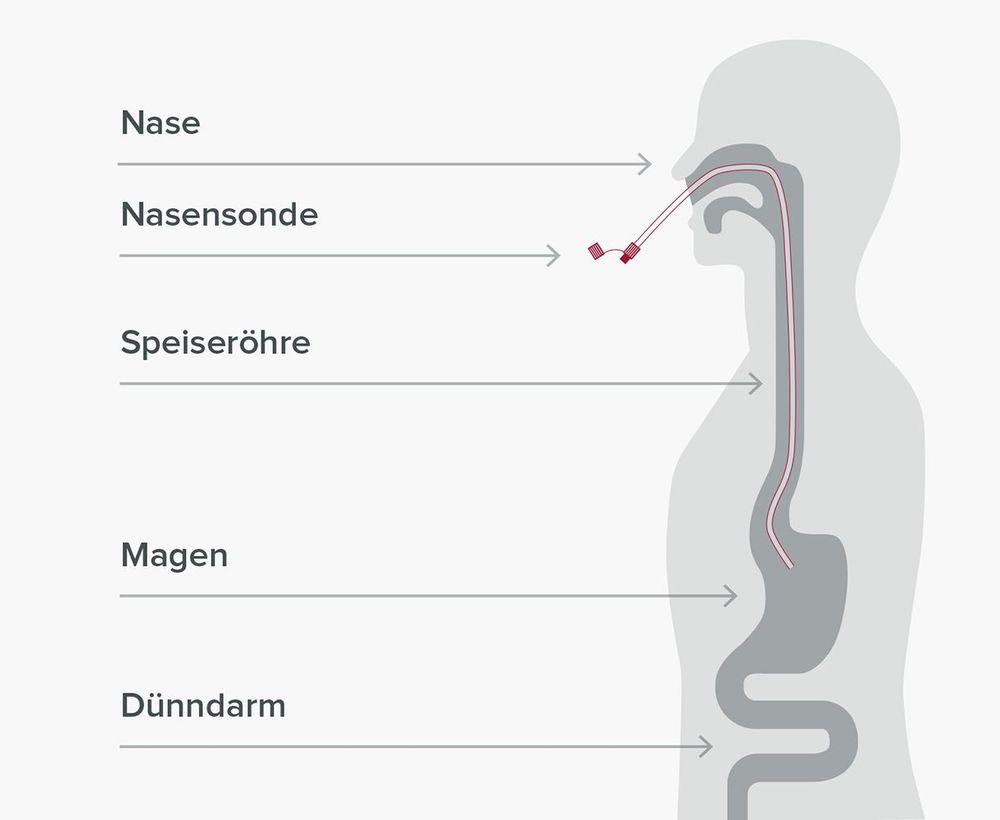 Nasensonde oder transnasale Sonde