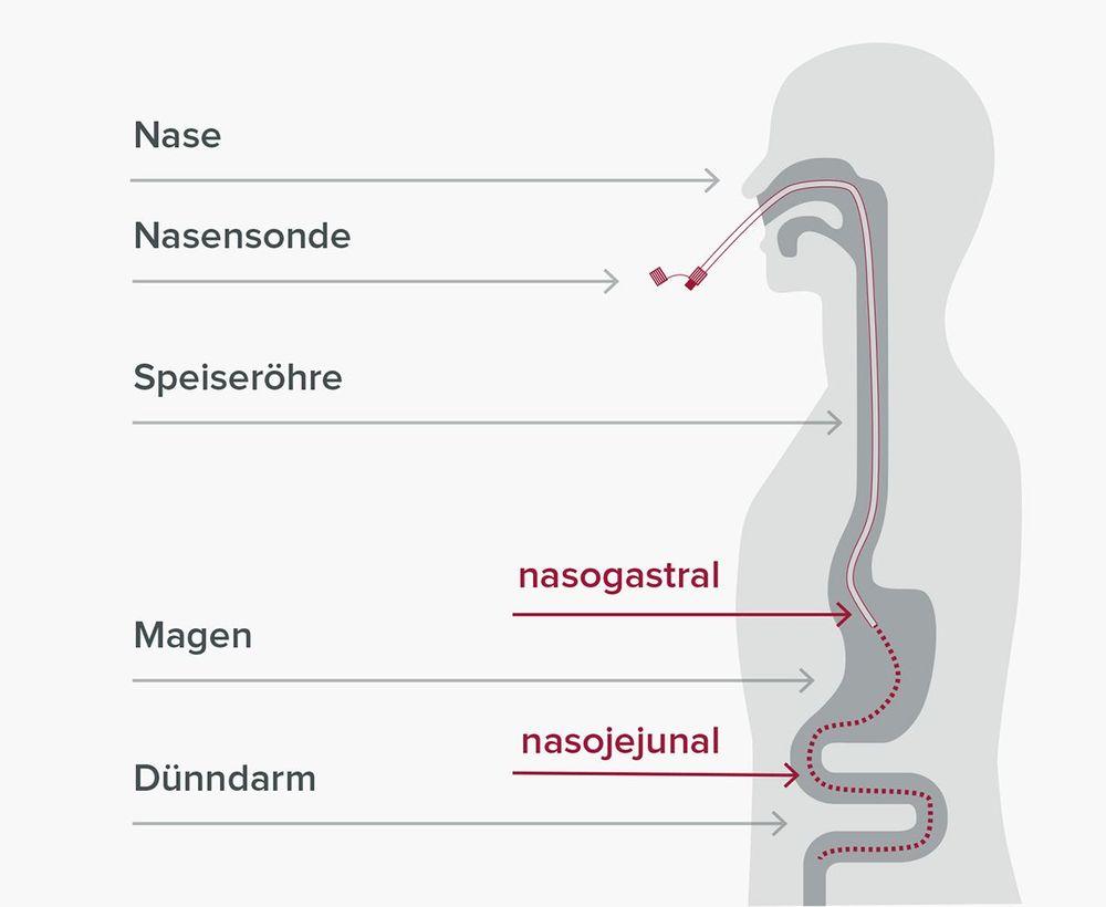 Nasointestinal Sonde