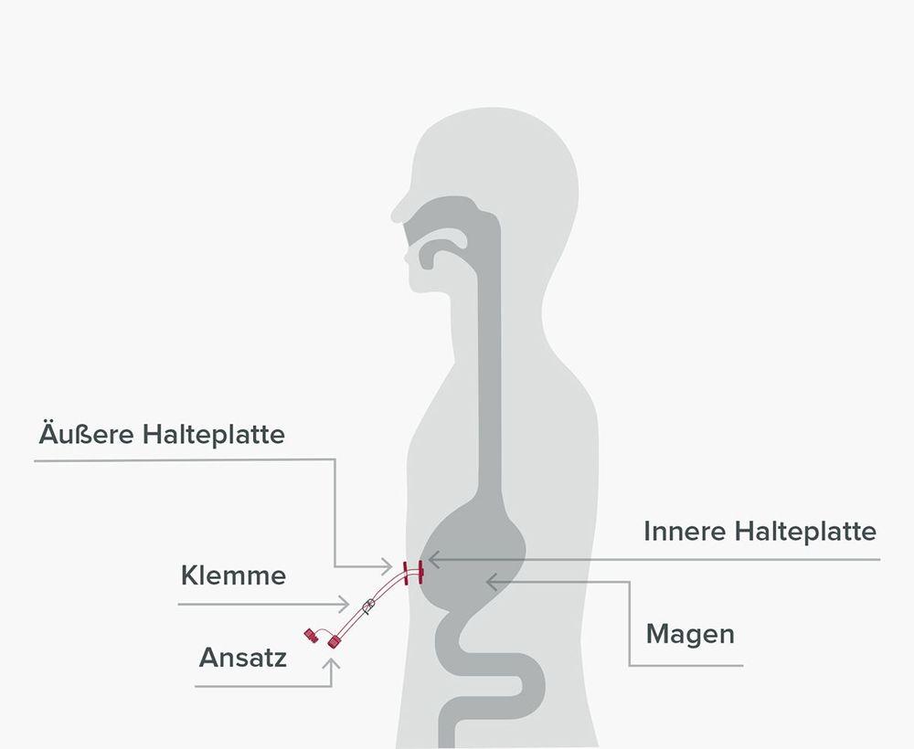 PEG-Sonde: Perkutane endoskopische Gastrostomie