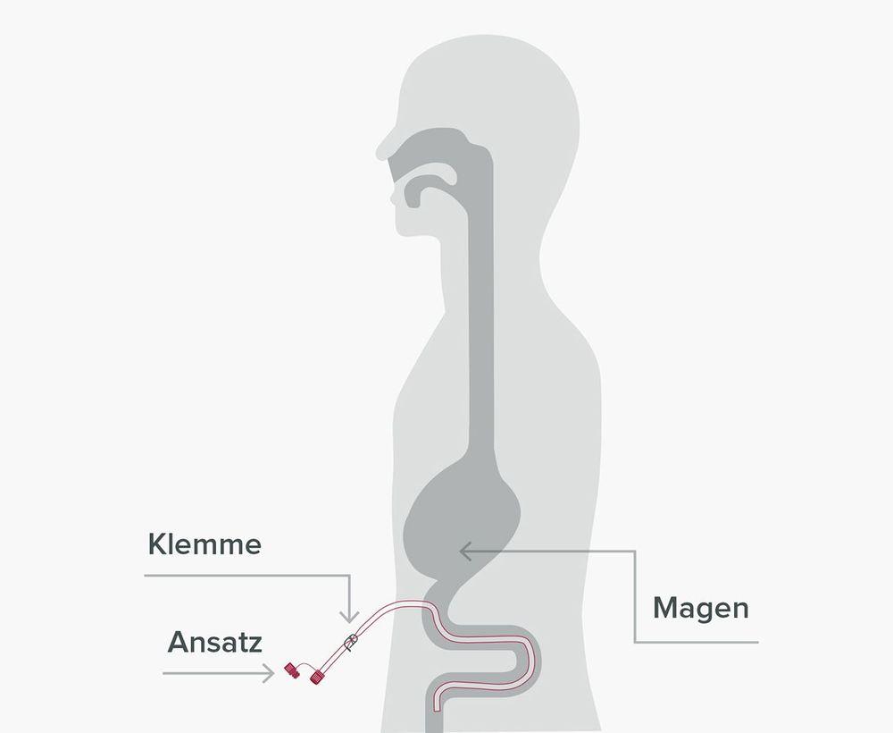 Die PEJ-Sonde ist eine perkutane Dünndarmsonde.