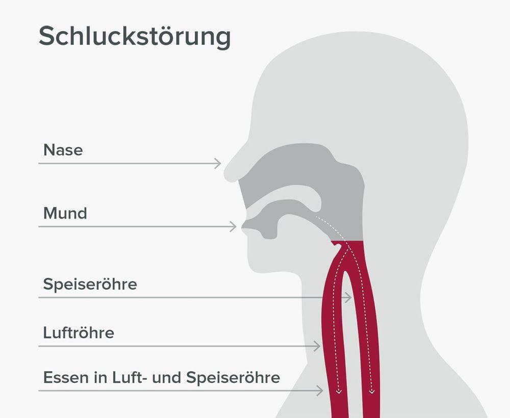 Schluckvorgang Schluckstörung (Dysphagie)