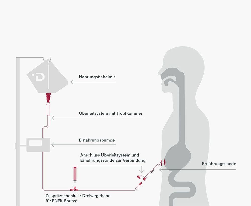 Pumpenapplikation Sondennahrung 