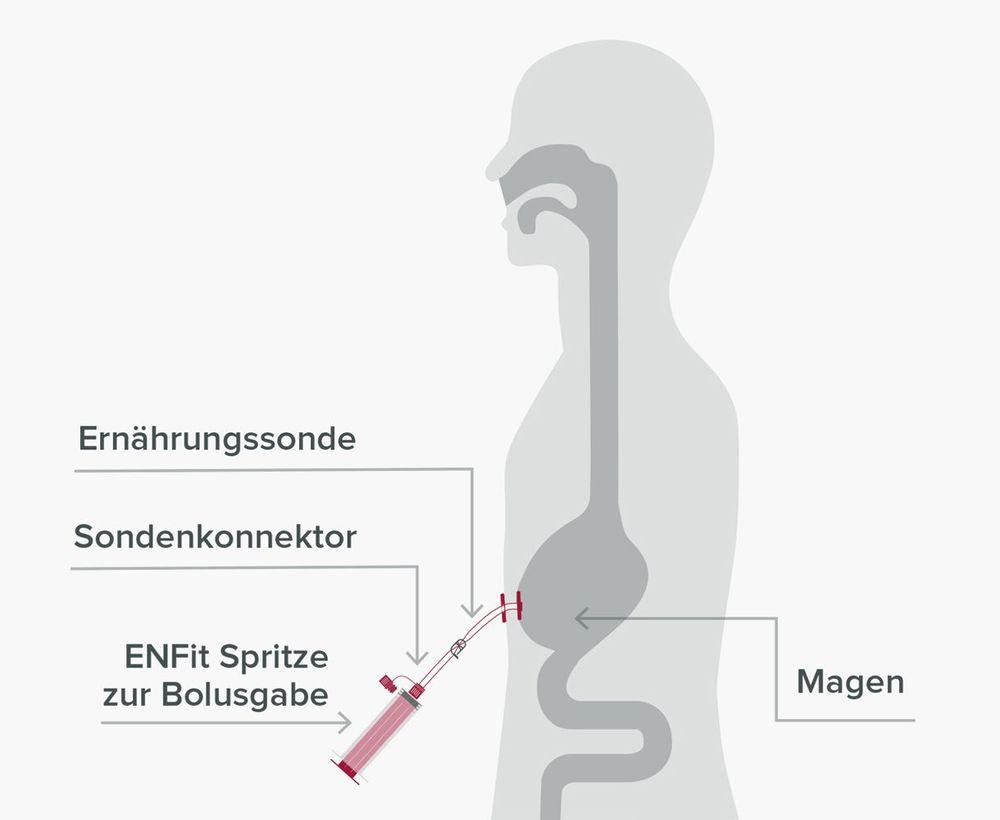 Bolusgabe Sondennahrung