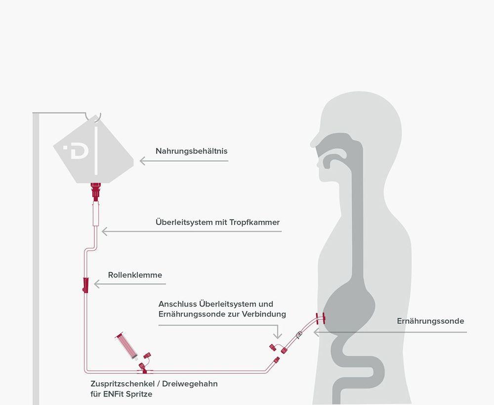 Verabreichung von Sondennahrung per Schwerkraft