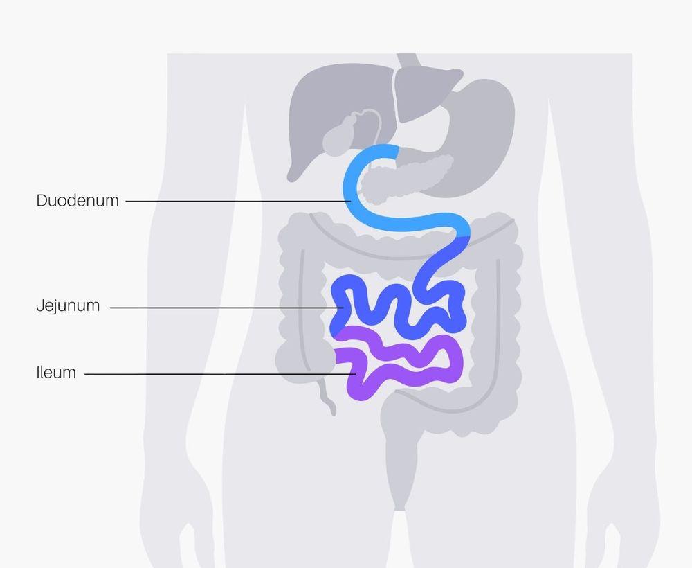Was ist eine Dünndarmsonde?