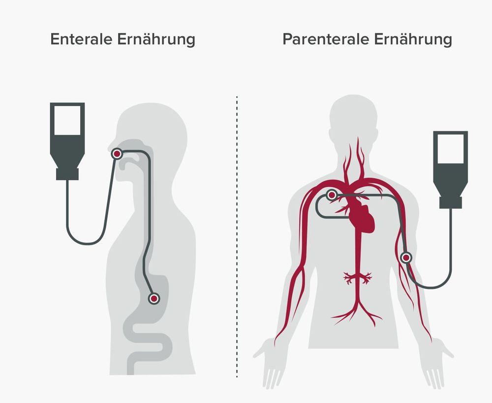 Enterale versus parenterale Ernährung: Unterschied