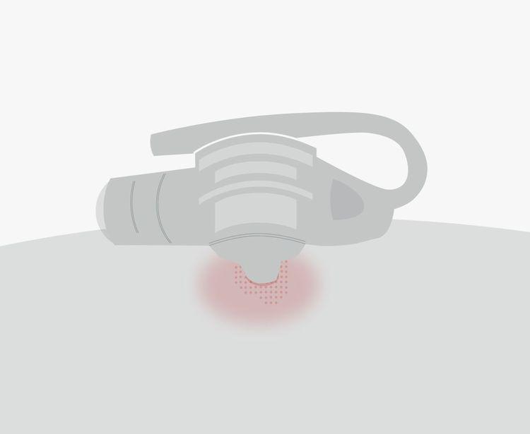 Wundinfektion Sonde