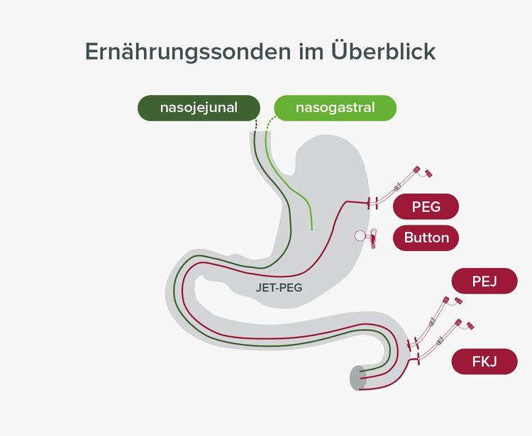 Arten von Ernährungssonden Arten von Ernährungssonden