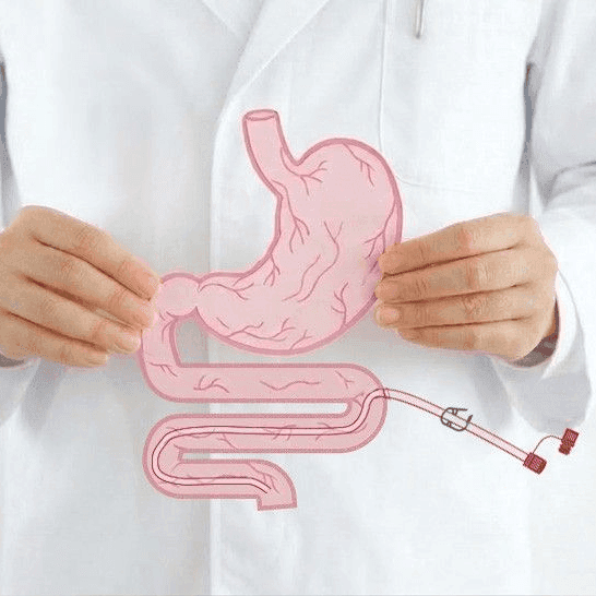 Perkutane Jejunalsonden (Dünndarmsonden) Perkutane Jejunalsonden (Dünndarmsonden)