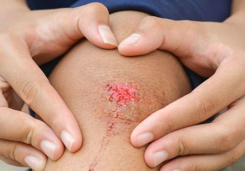 Wunde am Knie gerinnt mit Hilfe von Plasmaeiweiß Wunde am Knie gerinnt mit Hilfe von Plasmaeiweiß